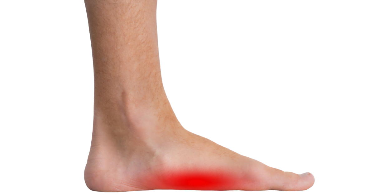 Pied affaissé | prévenir le pied plat