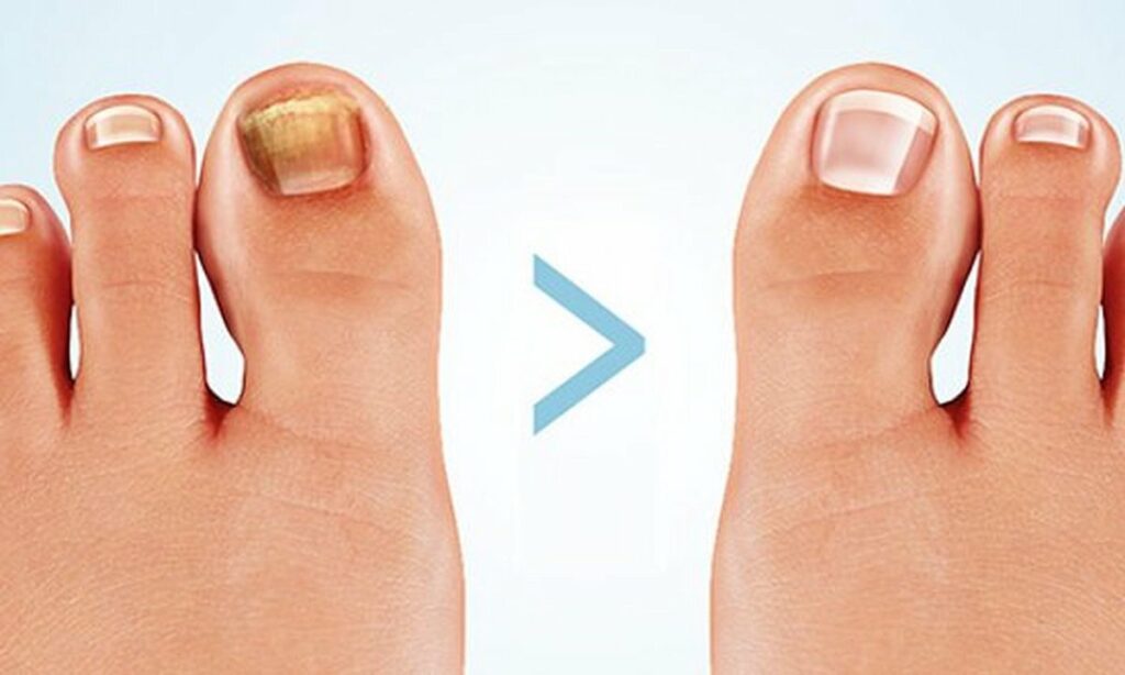 Traiter la mycose de l'ongle