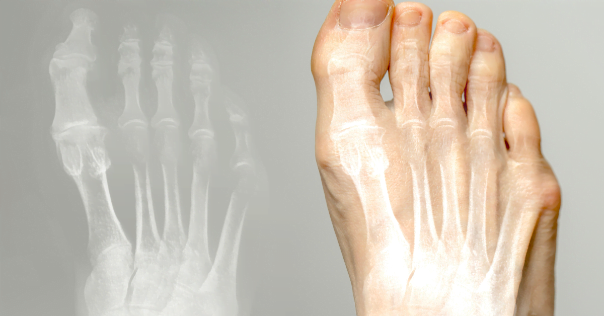 hallux-valgus-rontgen
