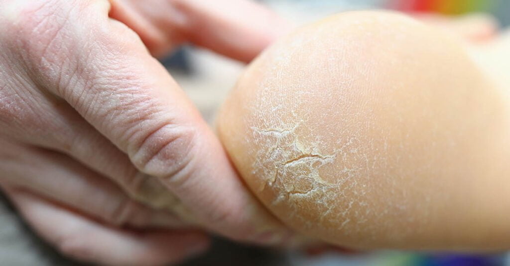 Crevasses aux talons sur le talon